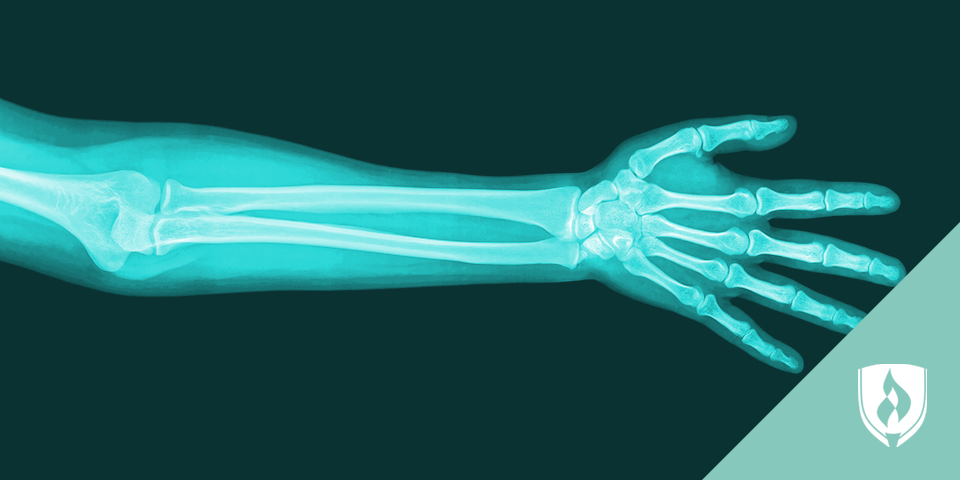 Xray of a hand and forearm