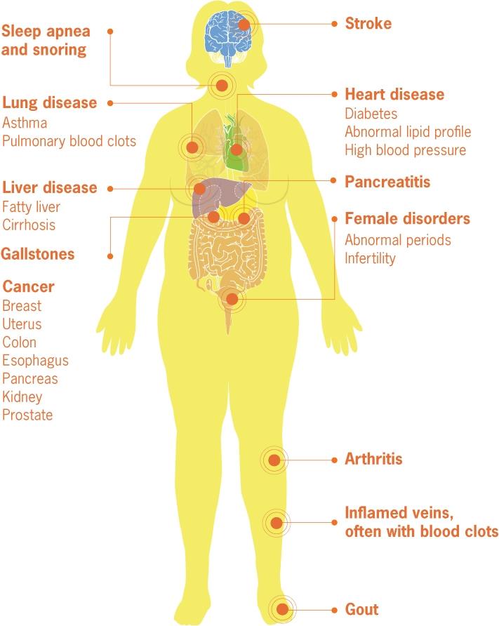 obesity health chart