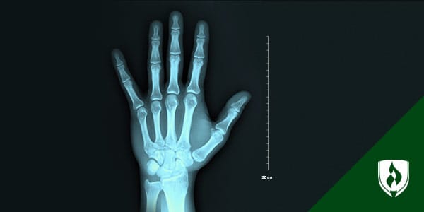 X-ray image of a hand.